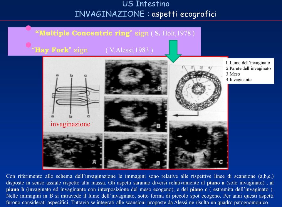 Gli aspetti saranno diversi relativamente al piano a (solo invaginato), al piano b (invaginato ed invaginante con interposizione del meso ecogeno), e del piano c ( estremità dell invaginato ).