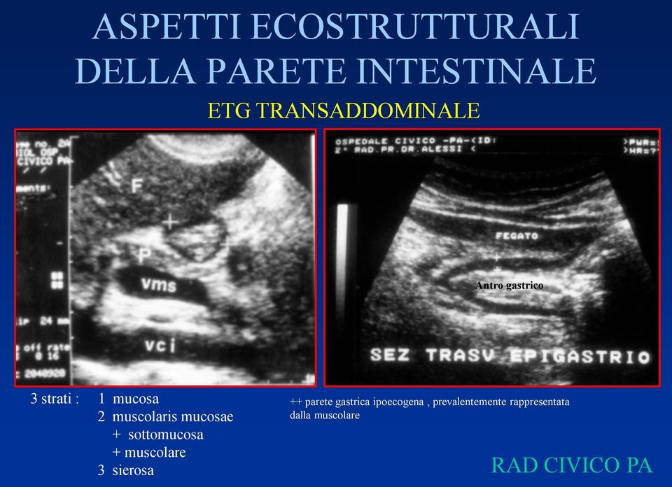 muscolaris mucosae + sottomucosa + muscolare 3 sierosa ++