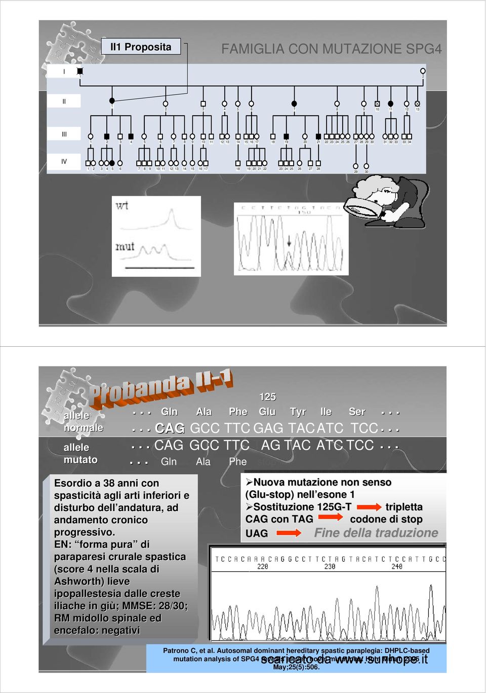 EN: forma pura di paraparesi crurale spastica (score 4 nella scala di Ashworth) ) lieve ipopallestesia dalle creste iliache in giù; ; MMSE: 8/30; RM midollo spinale ed encefalo: negativi 5.