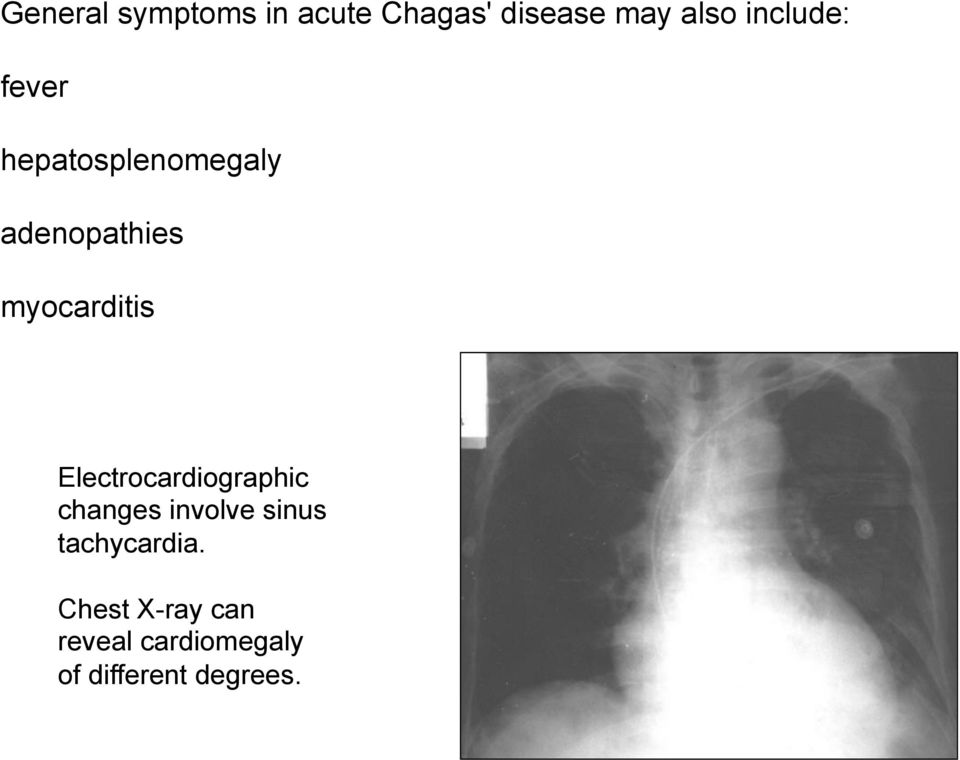 myocarditis Electrocardiographic changes involve sinus