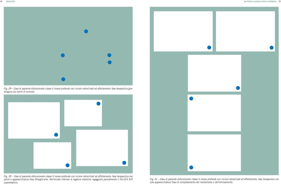 30 Caso di paziente disfunzionale classe II morso profondo con incisivi retroclinati ed affollamento: fase terapeutica con splint e apparecchiatura fissa Straight-wire.