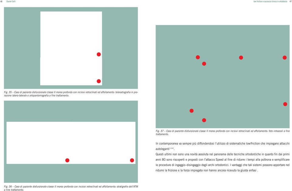 37 Caso di paziente disfunzionale classe II morso profondo con incisivi retroclinati ed affollamento: foto intraorali a fine trattamento.