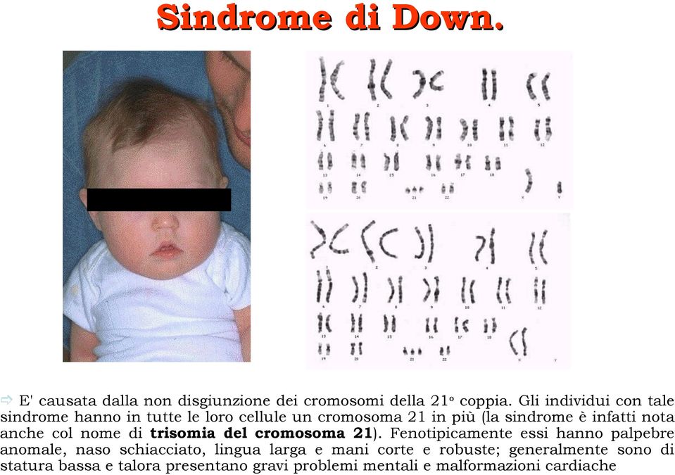 nota anche col nome di trisomia del cromosoma 21).