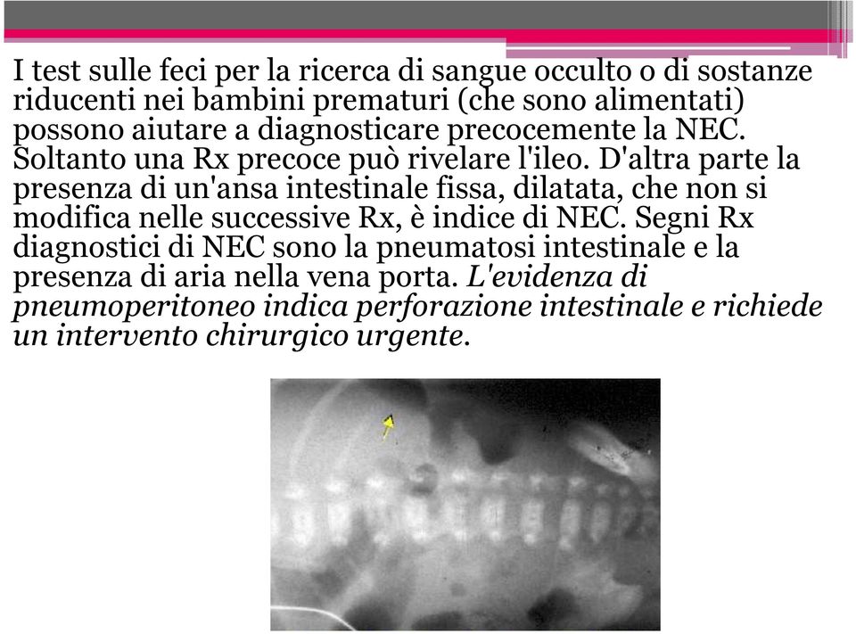 D'altra parte la presenza di un'ansa intestinale fissa, dilatata, che non si modifica nelle successive Rx, è indice di NEC.