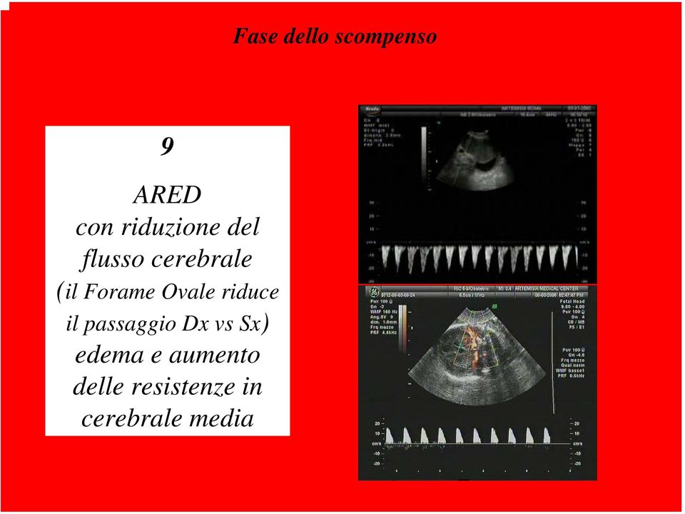 Forame Ovale riduce il passaggio Dx vs