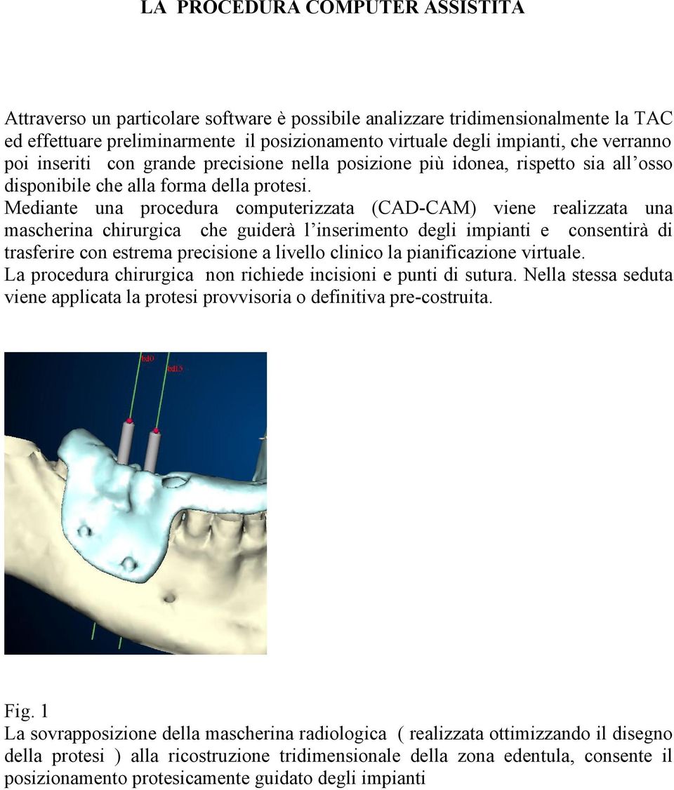 Mediante una procedura computerizzata (CAD-CAM) viene realizzata una mascherina chirurgica che guiderà l inserimento degli impianti e consentirà di trasferire con estrema precisione a livello clinico