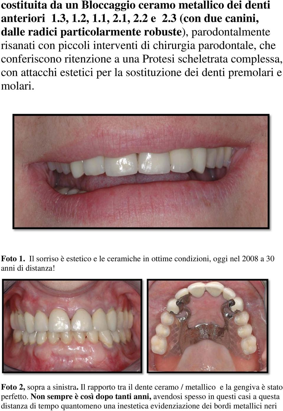 scheletrata complessa, con attacchi estetici per la sostituzione dei denti premolari e molari. Foto 1.