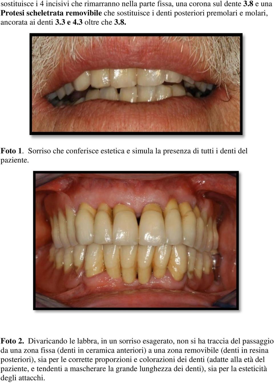 Sorriso che conferisce estetica e simula la presenza di tutti i denti del paziente. Foto 2.