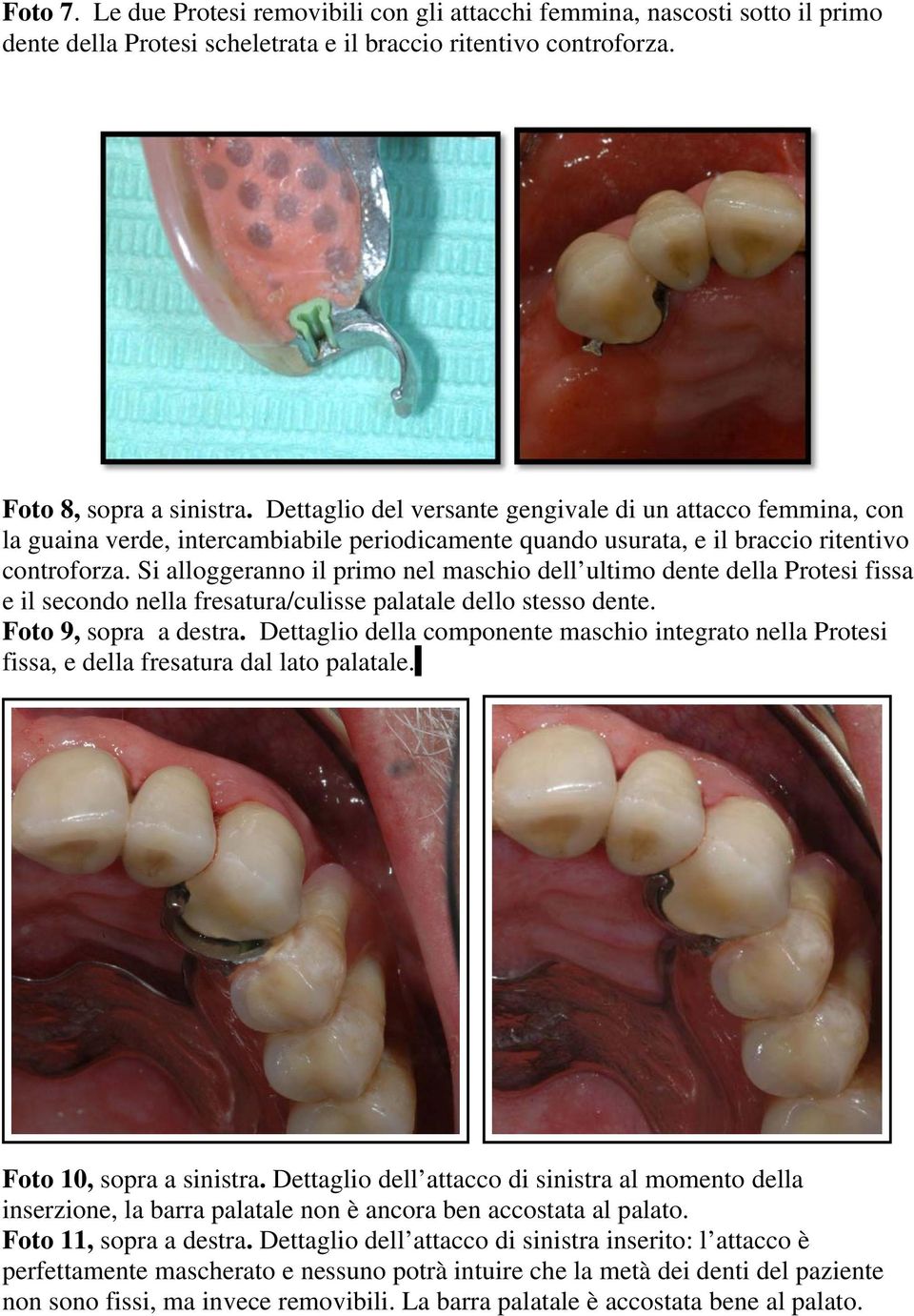 Si alloggeranno il primo nel maschio dell ultimo dente della Protesi fissa e il secondo nella fresatura/culisse palatale dello stesso dente. Foto 9, sopra a destra.