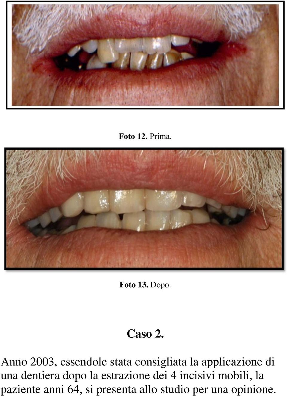 applicazione di una dentiera dopo la estrazione