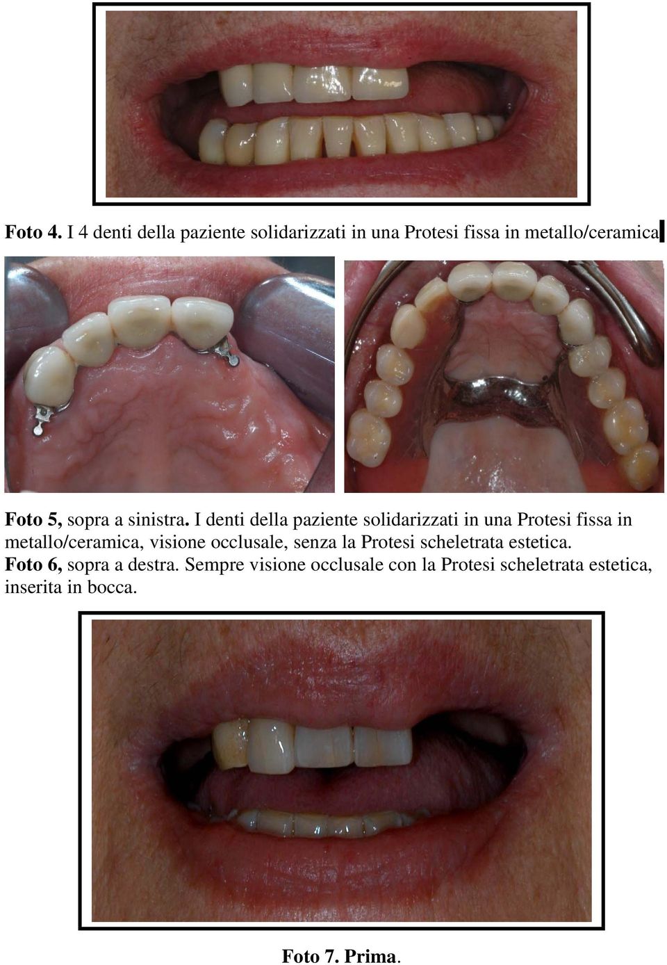 I denti della paziente solidarizzati in una Protesi fissa in metallo/ceramica, visione