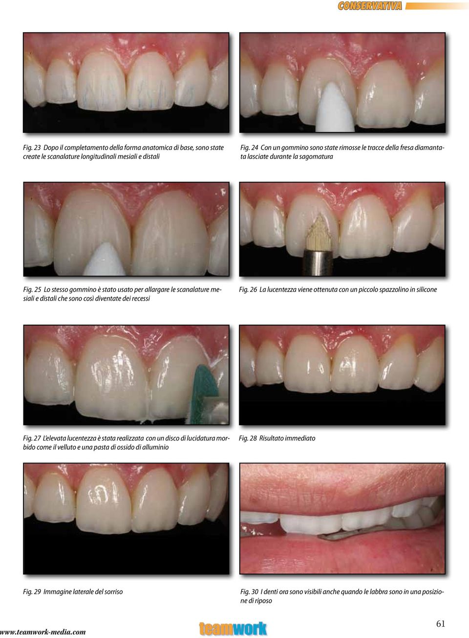 25 Lo stesso gommino è stato usato per allargare le scanalature mesiali e distali che sono così diventate dei recessi Fig.