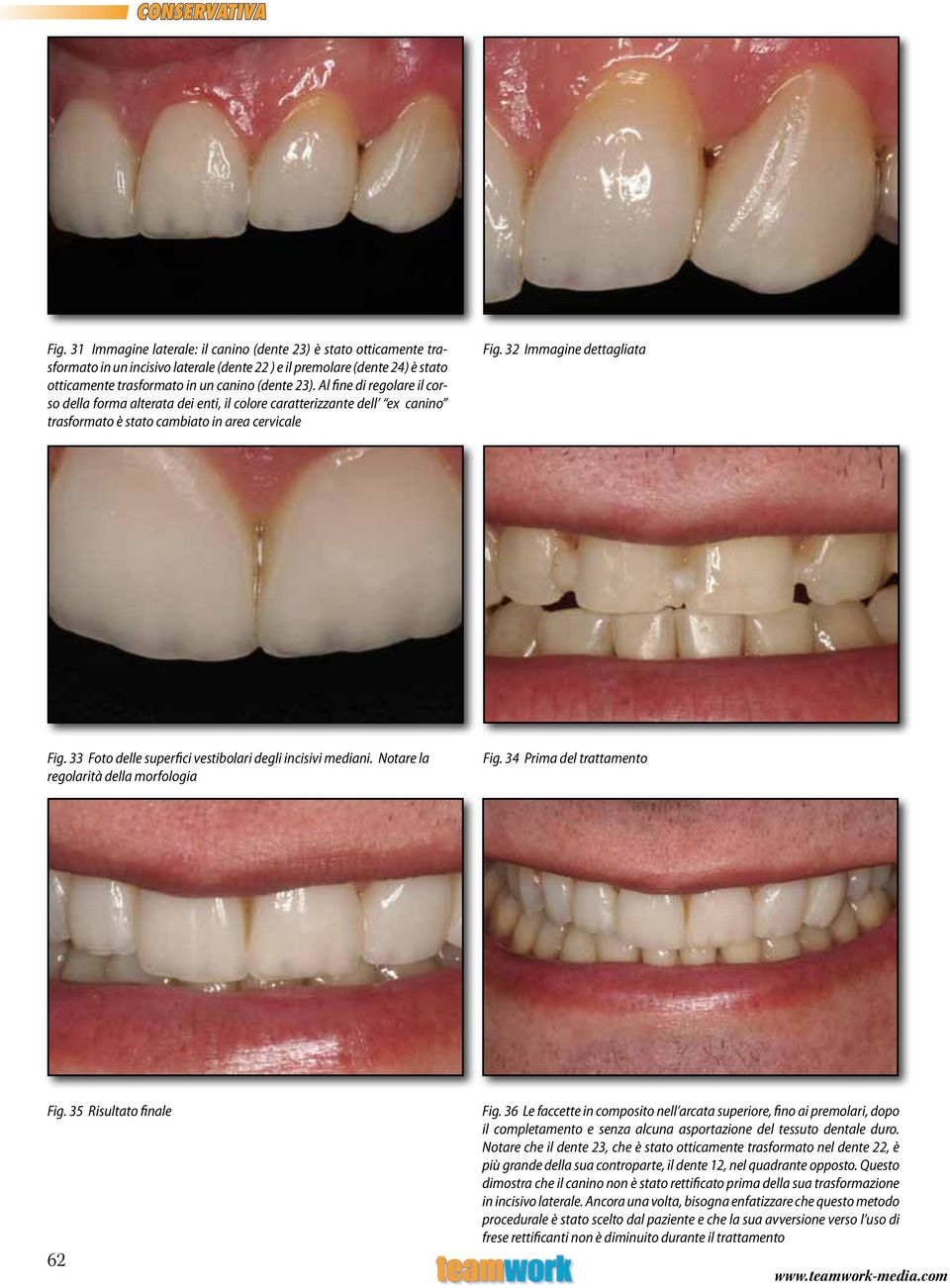 33 Foto delle superfici vestibolari degli incisivi mediani. Notare la regolarità della morfologia Fig. 34 Prima del trattamento Fig. 35 Risultato finale 62 Fig.