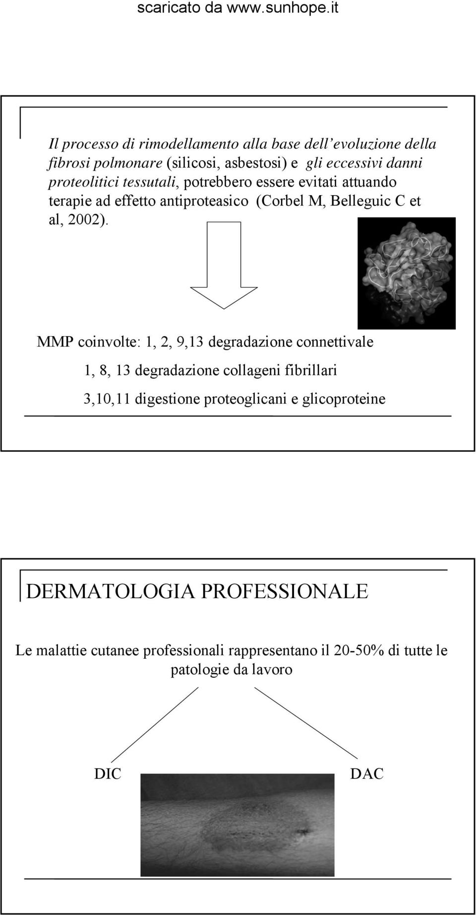 MMP coinvolte: 1, 2, 9,13 degradazione connettivale 1, 8, 13 degradazione collageni fibrillari 3,10,11 digestione proteoglicani e
