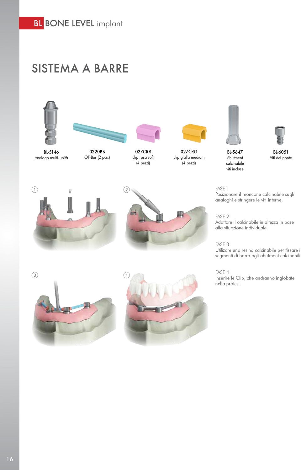 FASE 1 Posizionare il moncone calcinabile sugli analoghi e stringere le viti interne.