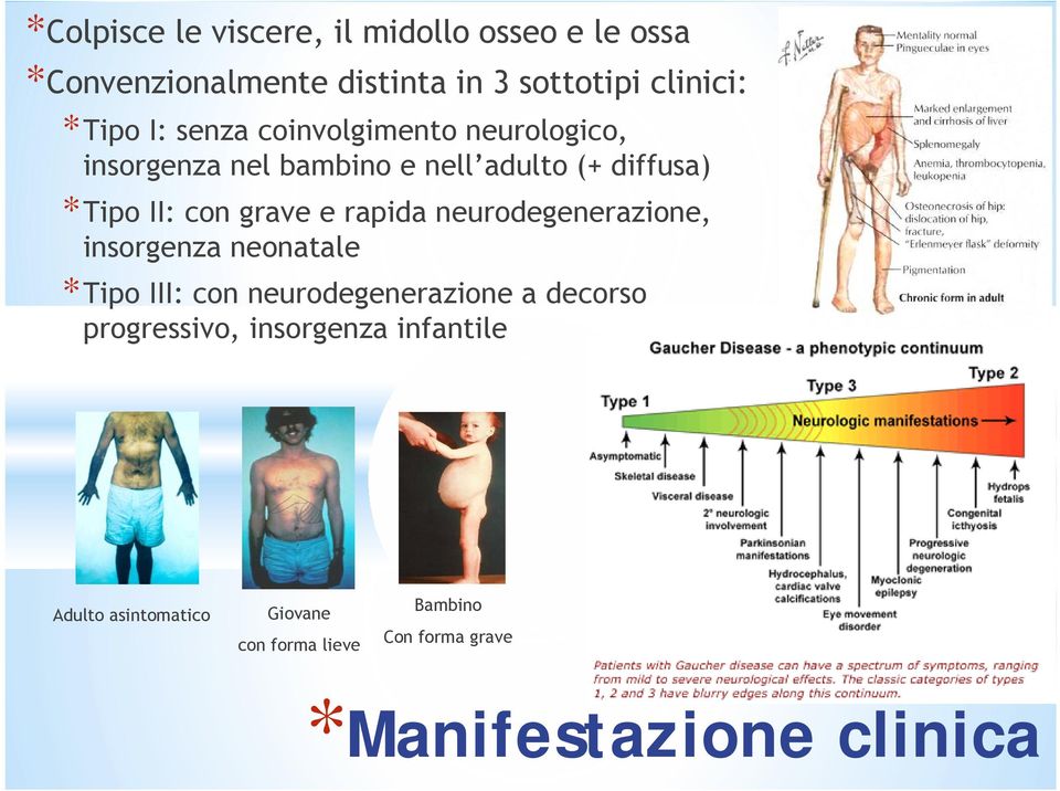 rapida neurodegenerazione, insorgenza neonatale *Tipo III: con neurodegenerazione a decorso progressivo,