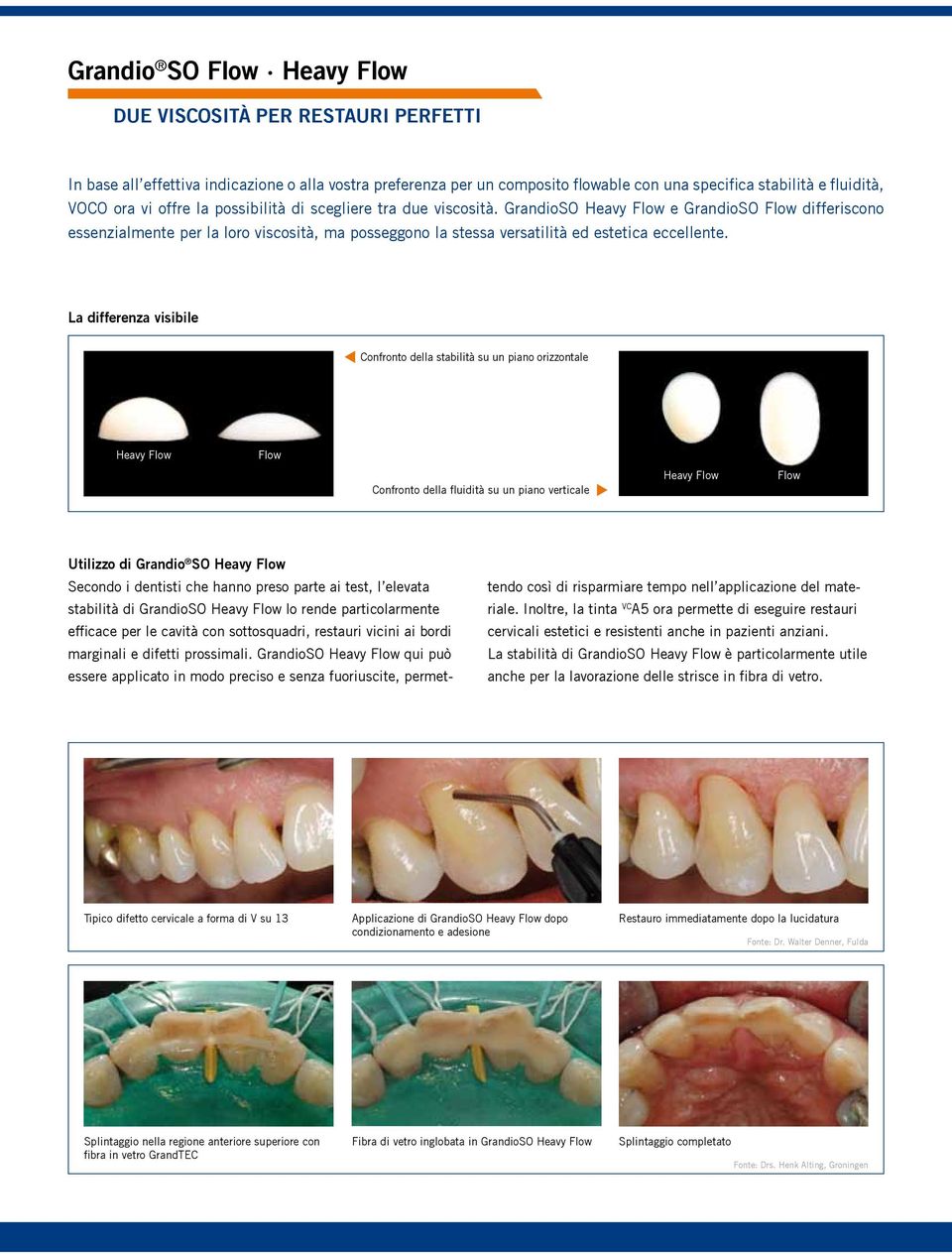 La differenza visibile Confronto della stabilità su un piano orizzontale Heavy Confronto della fluidità su un piano verticale Heavy Utilizzo di Grandio SO Heavy Secondo i dentisti che hanno preso