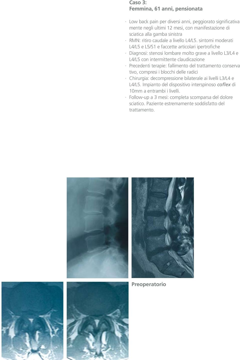 sintomi moderati L4/L5 e L5/S1 e faccette articolari ipertrofiche Diagnosi: stenosi lombare molto grave a livello L3/L4 e L4/L5 con intermittente claudicazione Precedenti terapie: