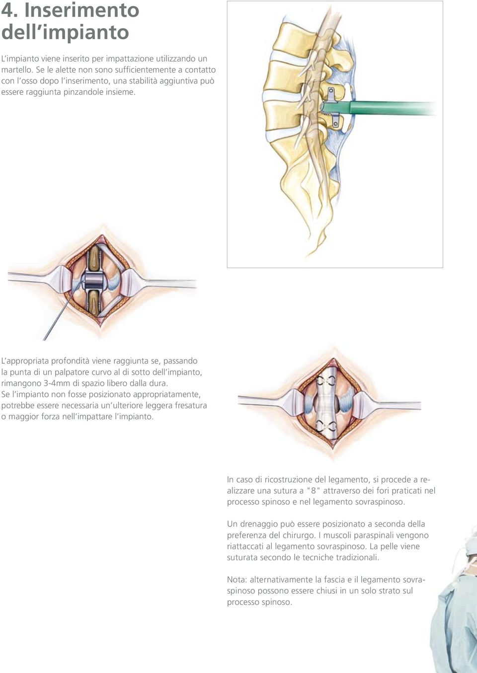 L appropriata profondità viene raggiunta se, passando la punta di un palpatore curvo al di sotto dell impianto, rimangono 3-4mm di spazio libero dalla dura.