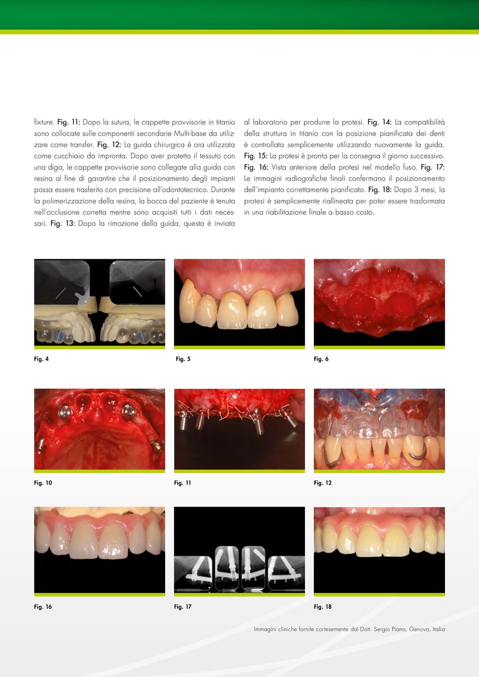 precisione all odontotecnico. Durante la polimerizzazione della resina, la bocca del paziente è tenuta nell occlusione corretta mentre sono acquisiti tutti i dati necessari. Fig.