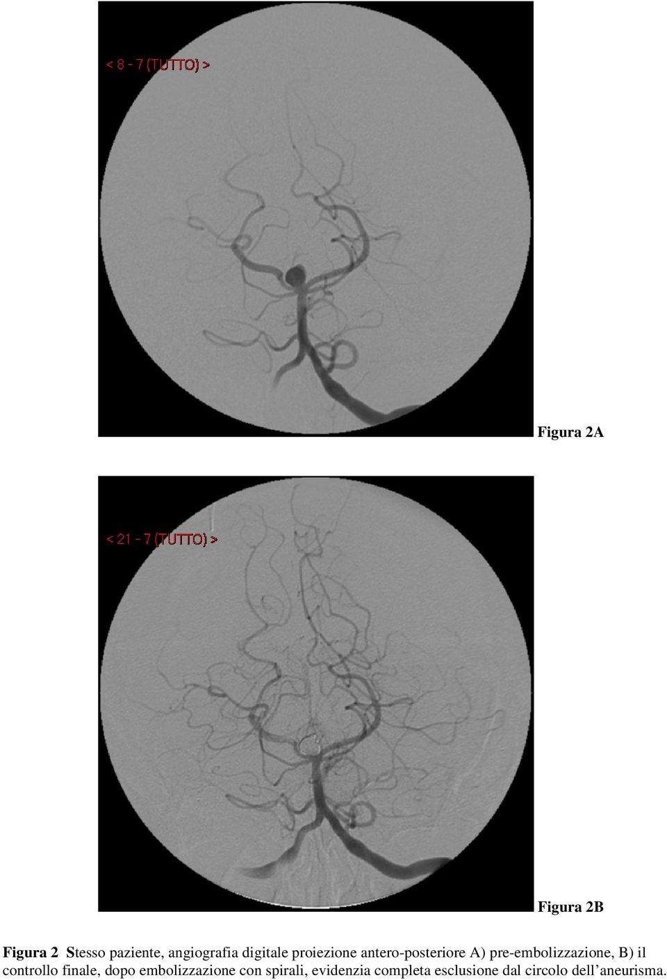 pre-embolizzazione, B) il controllo finale, dopo