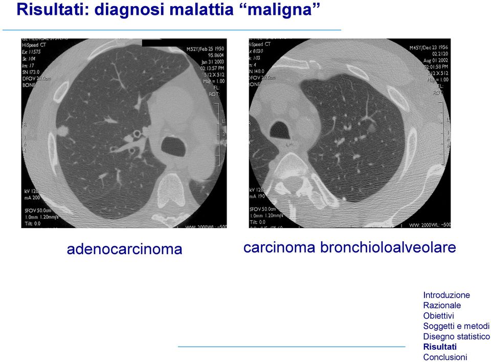 adenocarcinoma