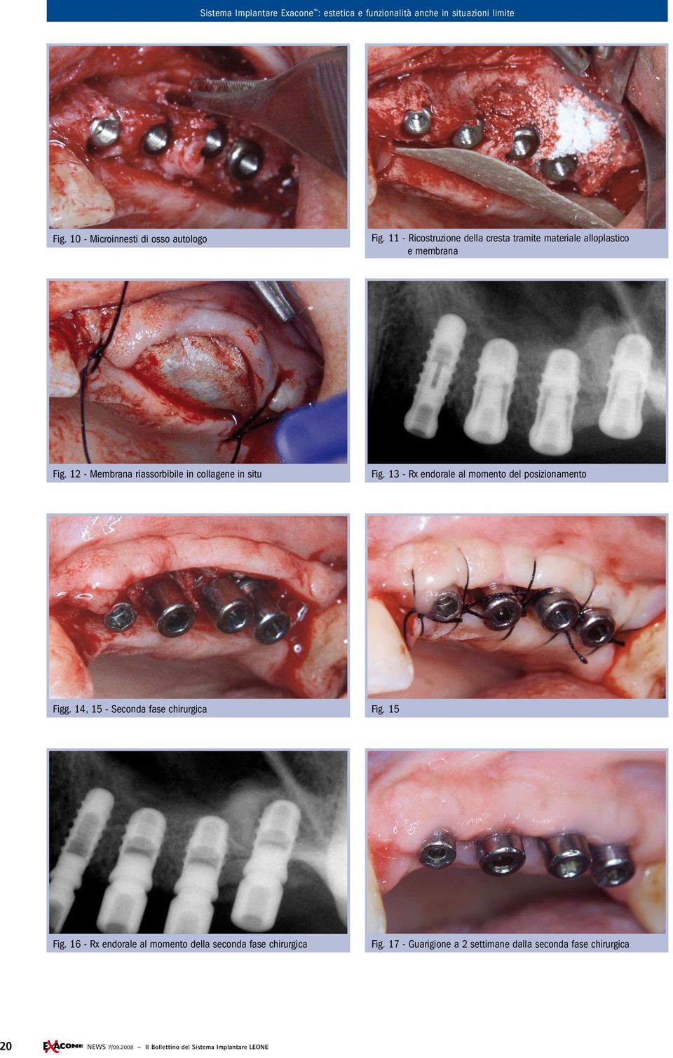 12 - Membrana riassorbibile in collagene in situ Fig. 13 - Rx endorale al momento del posizionamento Figg.