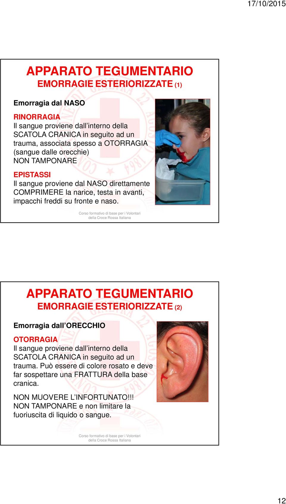 fronte e naso. EMORRAGIE ESTERIORIZZATE (2) Emorragia dall ORECCHIO OTORRAGIA Il sangue proviene dall interno della SCATOLA CRANICA in seguito ad un trauma.