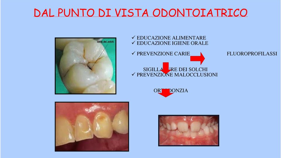 PREVENZIONE CARIE FLUOROPROFILASSI