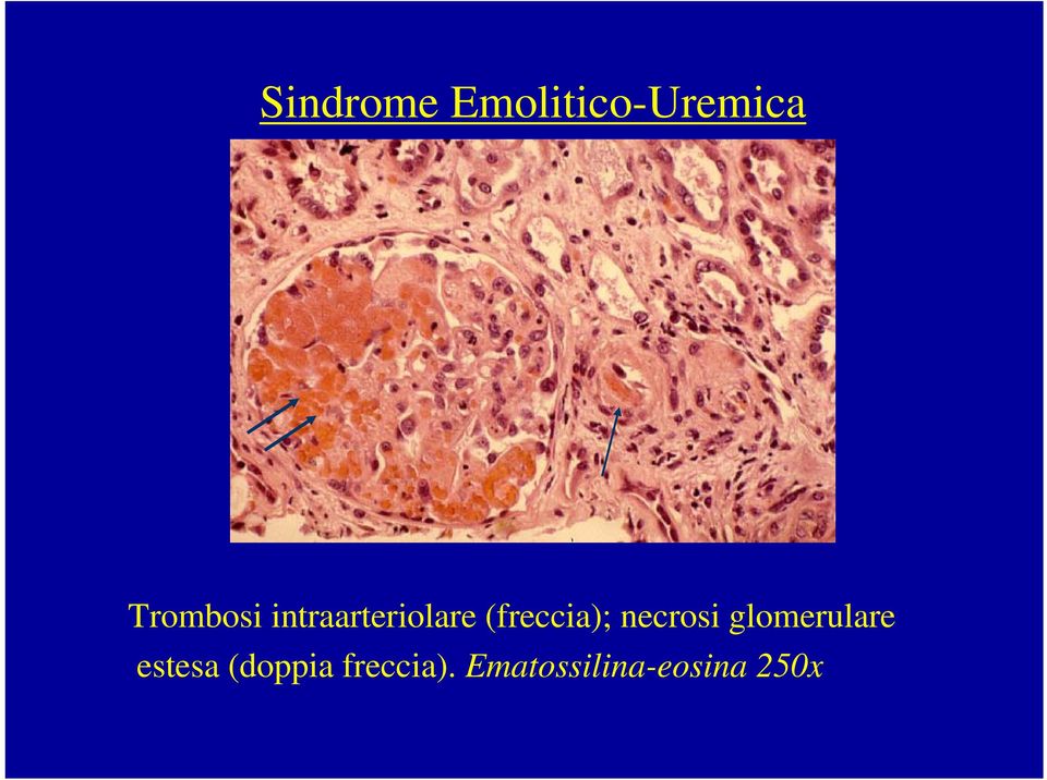 glomerulare estesa (doppia