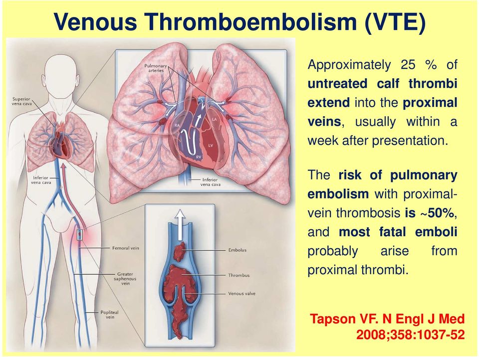The risk of pulmonary embolism with proximalvein thrombosis is ~50%, and most