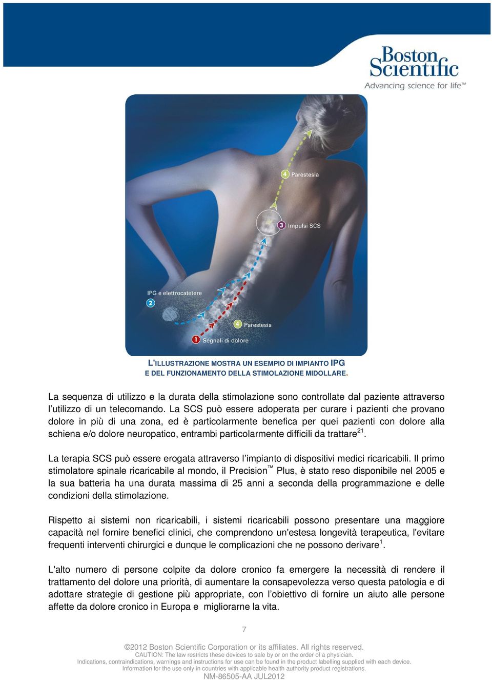 La SCS può essere adoperata per curare i pazienti che provano dolore in più di una zona, ed è particolarmente benefica per quei pazienti con dolore alla schiena e/o dolore neuropatico, entrambi