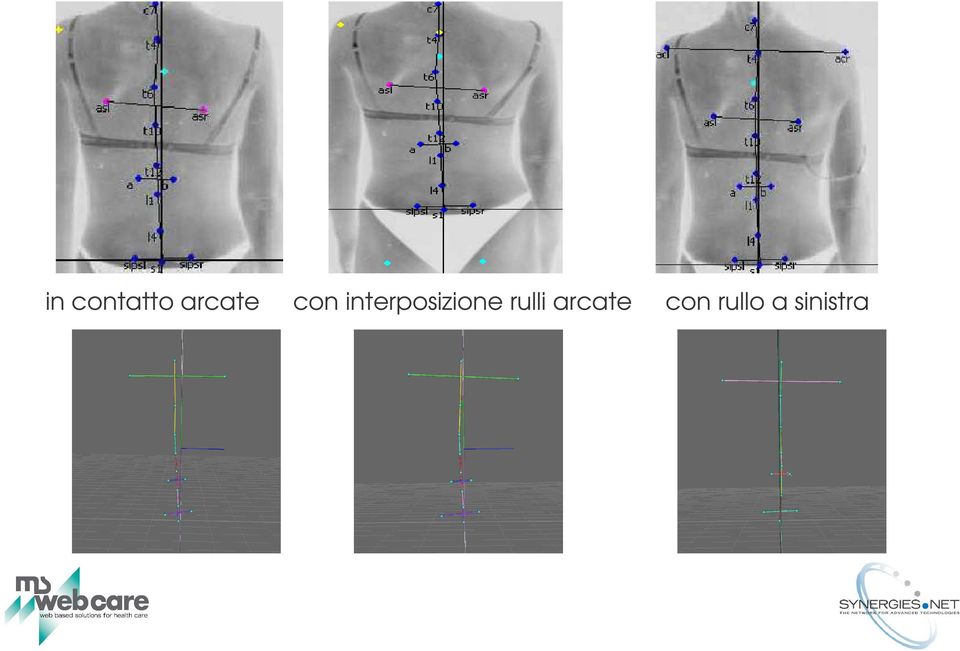 arcate con interposizione