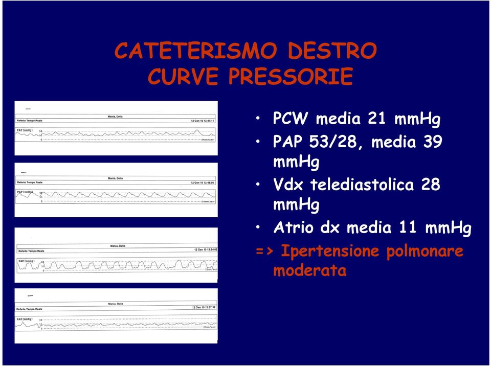 Vdx telediastolica 28 mmhg Atrio dx