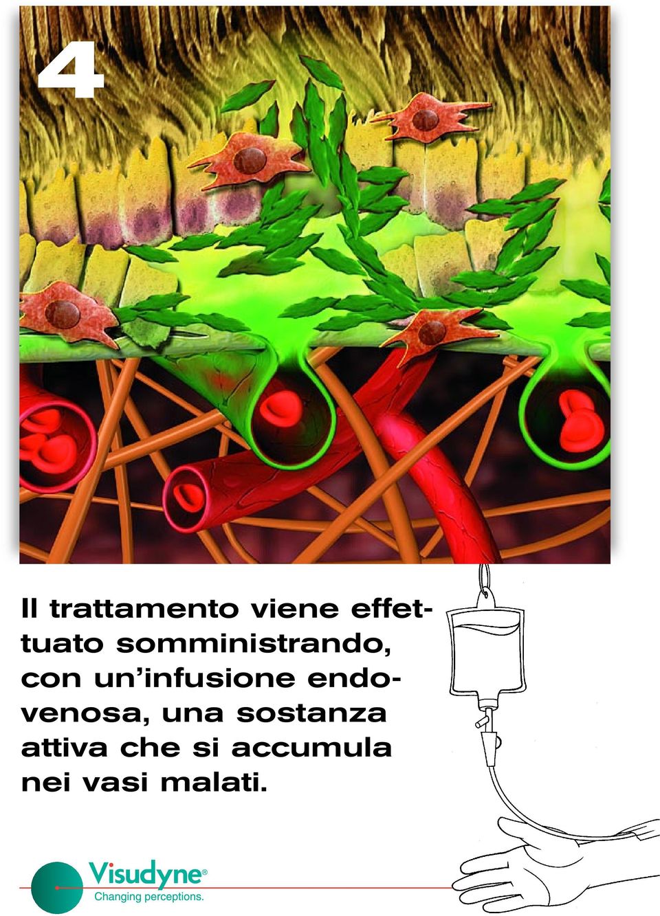 un infusione endovenosa, una