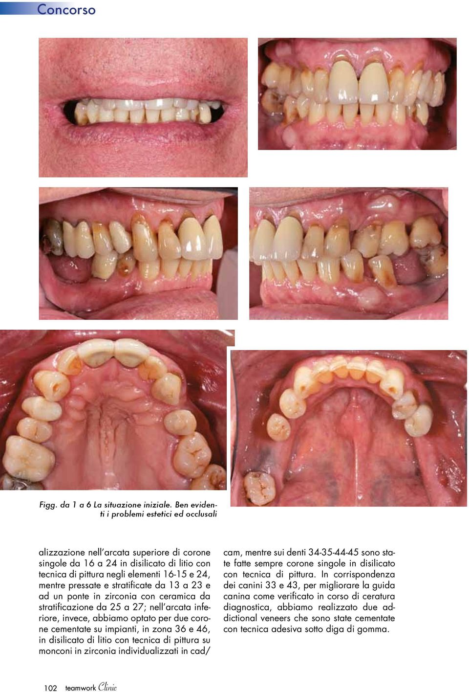 stratificate da 13 a 23 e ad un ponte in zirconia con ceramica da stratificazione da 25 a 27; nell arcata inferiore, invece, abbiamo optato per due corone cementate su impianti, in zona 36 e 46, in