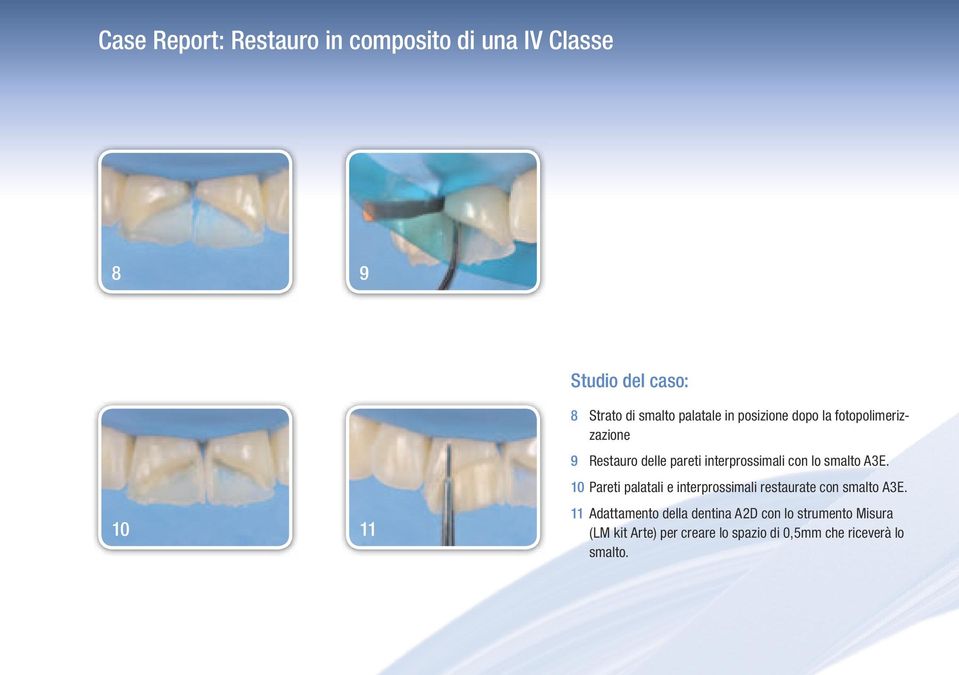 smalto A3E. 10 Pareti palatali e interprossimali restaurate con smalto A3E.