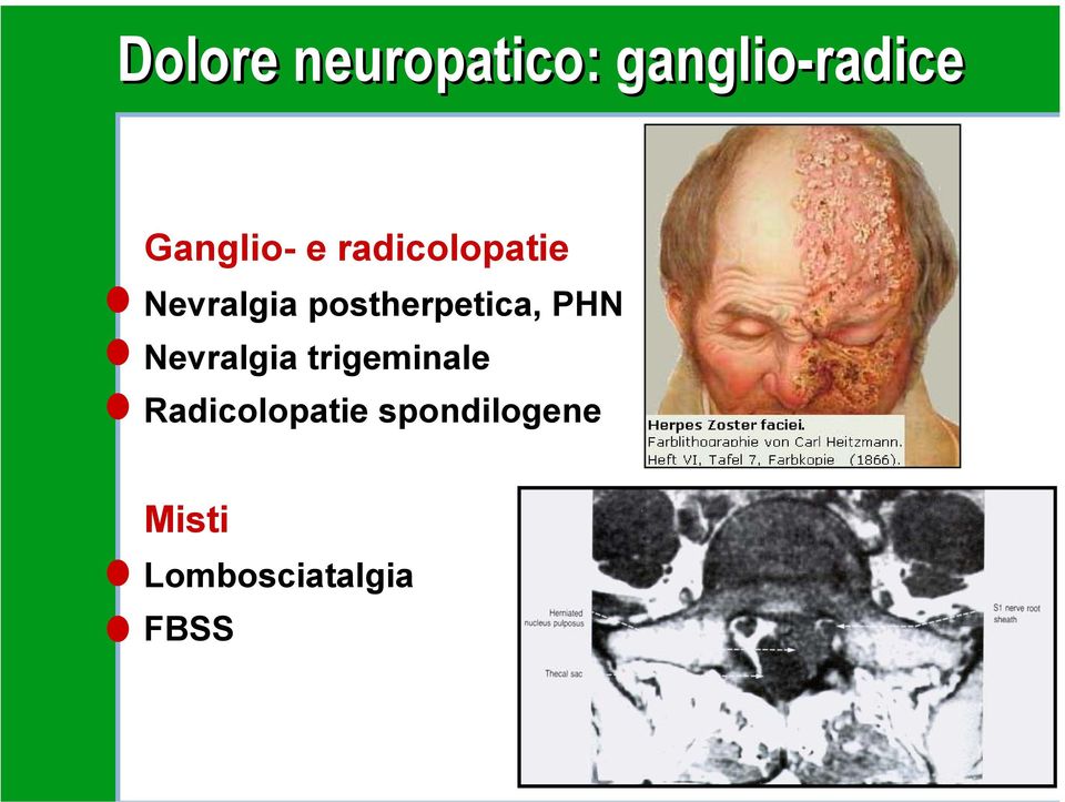 postherpetica, PHN Nevralgia trigeminale