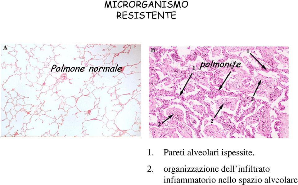 Pareti alveolari ispessite. 2.