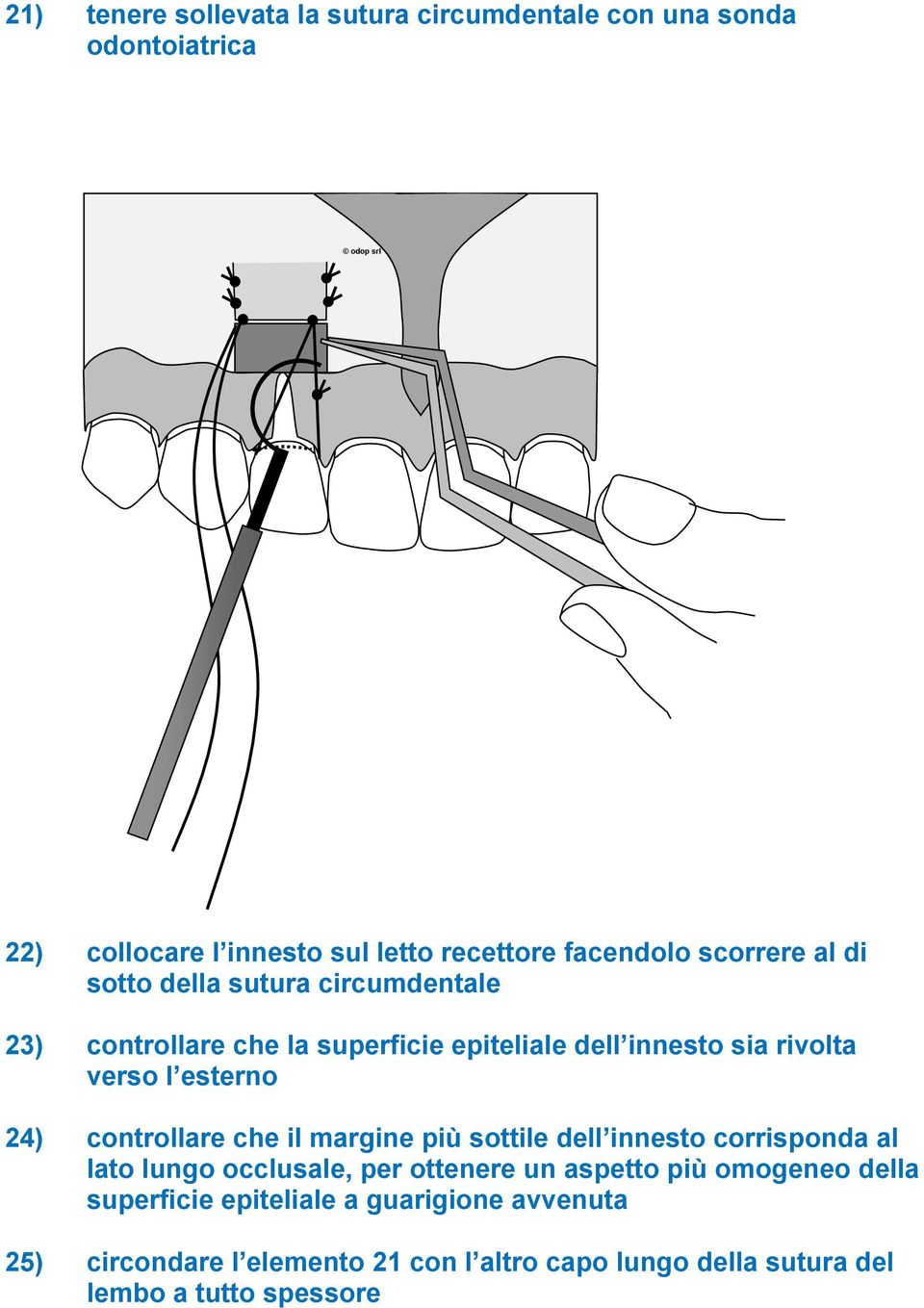 24) controllare che il margine più sottile dell innesto corrisponda al lato lungo occlusale, per ottenere un aspetto più omogeneo