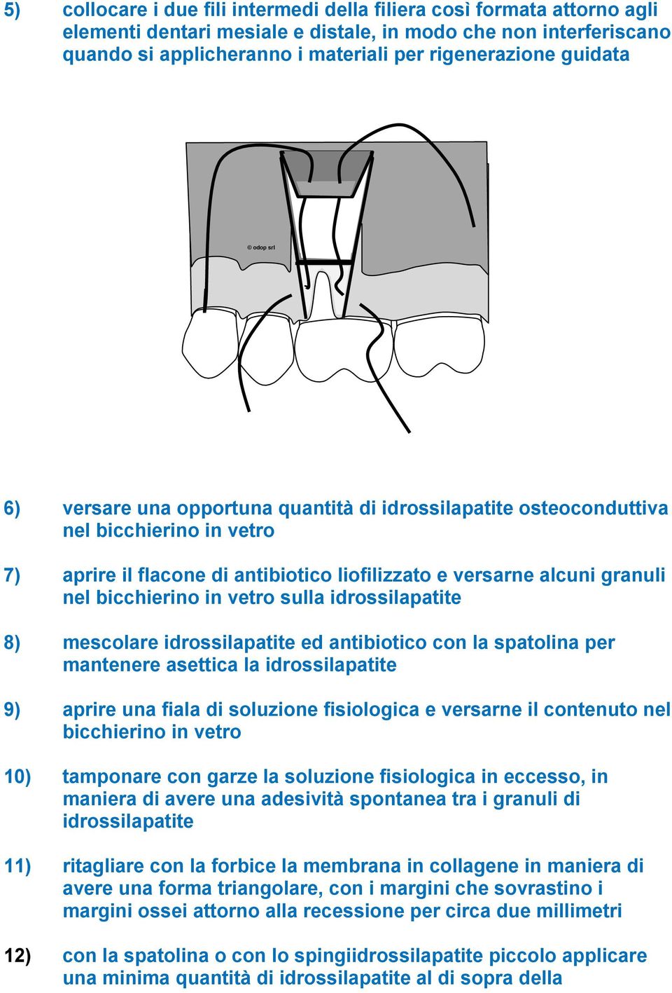 vetro sulla idrossilapatite 8) mescolare idrossilapatite ed antibiotico con la spatolina per mantenere asettica la idrossilapatite 9) aprire una fiala di soluzione fisiologica e versarne il contenuto