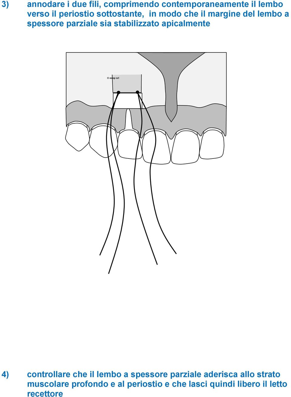 stabilizzato apicalmente 4) controllare che il lembo a spessore parziale aderisca