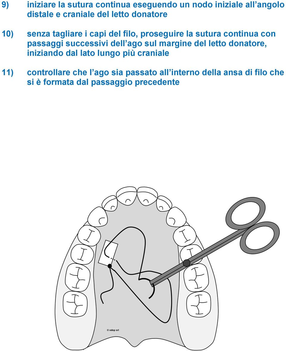 successivi dell ago sul margine del letto donatore, iniziando dal lato lungo più craniale 11)