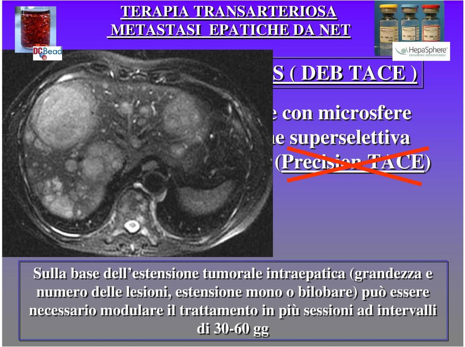 base dell estensione tumorale intraepatica (grandezza e numero delle lesioni, estensione