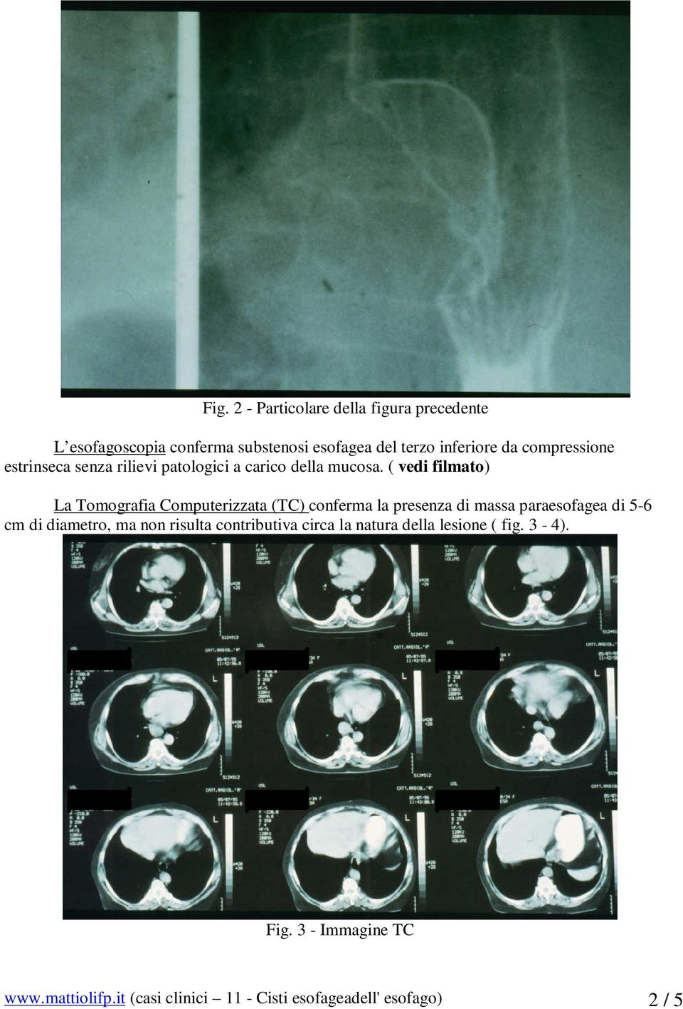 ( vedi filmato) La Tomografia Computerizzata (TC) conferma la presenza di massa paraesofagea di 5-6 cm di diametro,