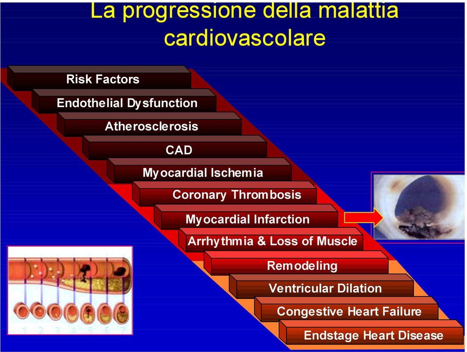 Coronary Thrombosis Myocardial Infarction Arrhythmia & Loss of