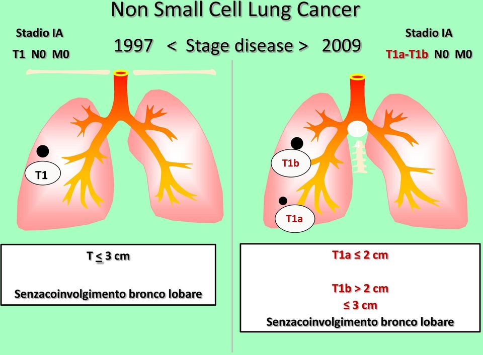 4 T1a T < 3 cm Senzacoinvolgimento bronco lobare T1a