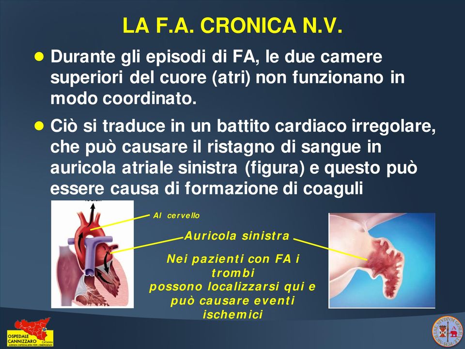 Ciò si traduce in un battito cardiaco irregolare, che può causare il ristagno di sangue in auricola