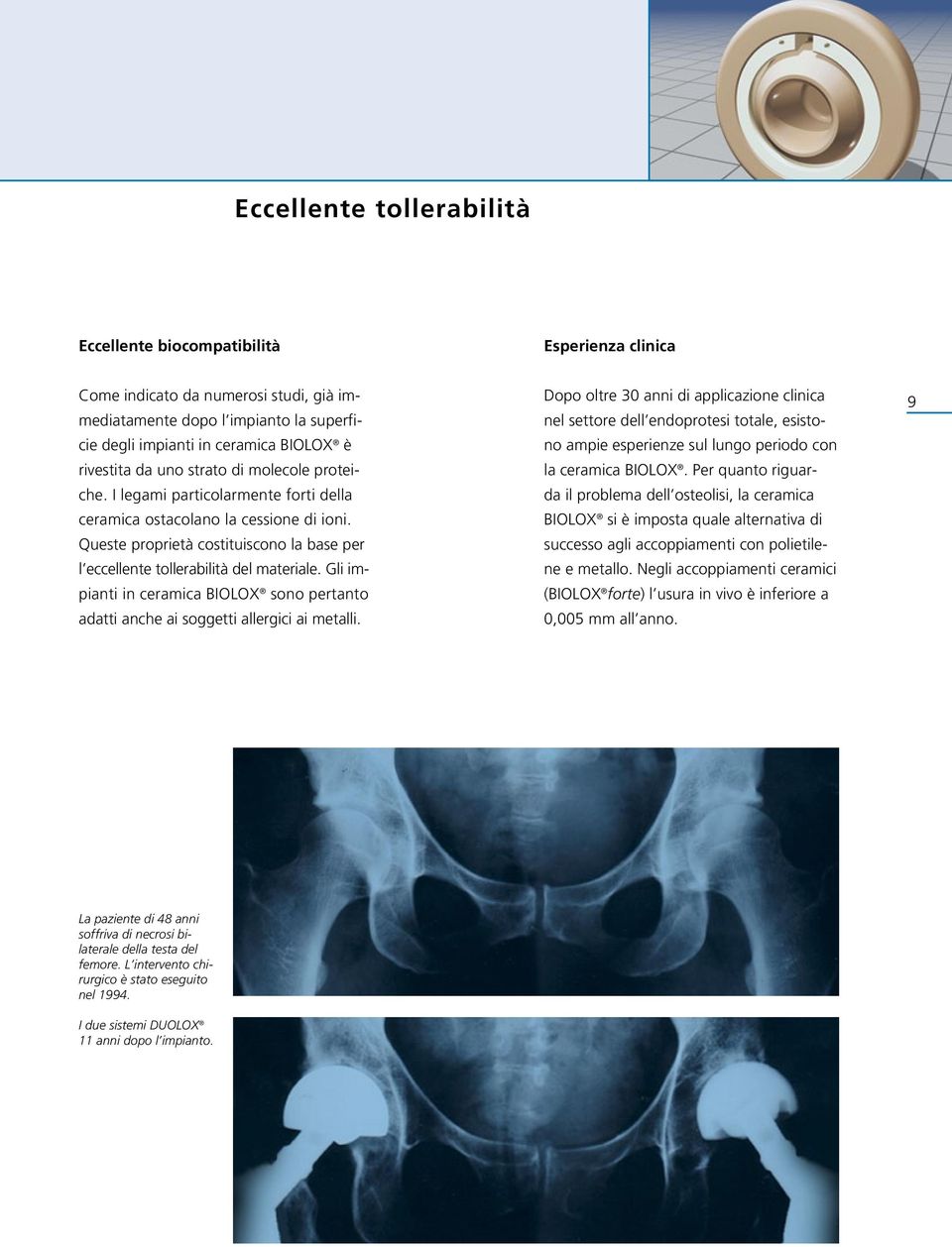 Gli impianti in ceramica BIOLOX sono pertanto adatti anche ai soggetti allergici ai metalli.