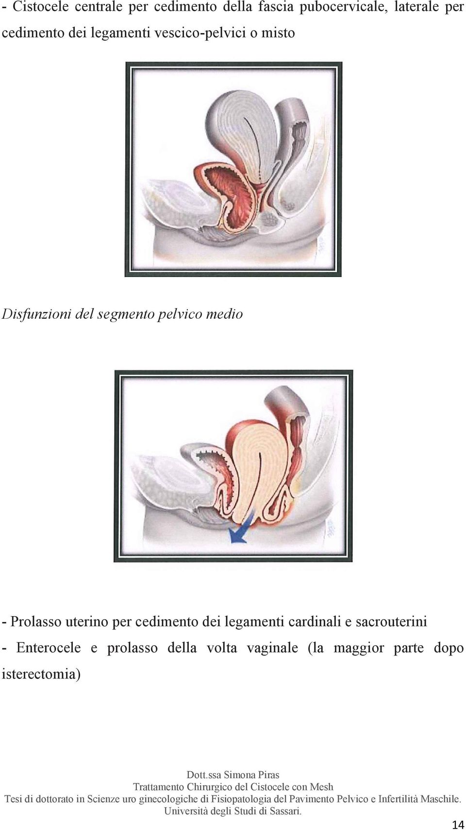 pelvico medio - Prolasso uterino per cedimento dei legamenti cardinali e